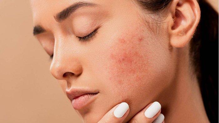 Ilustrasi kulit yang mengalami rosacea, berikut ini beberapa jenis rosacea