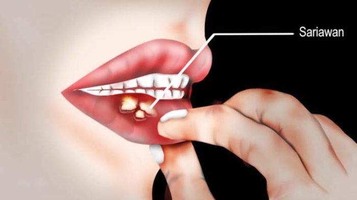 ilustrasi seseorang yang mengalami sariawan