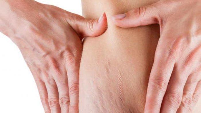 Ilustrasi stretch mark, berikut ini penjelasan dr. Irmadani Intan Pratiwi mengenai stretch mark yang bisa timbul di usia remaja