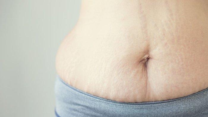 ilustrasi stretchmark pasca melahirkan