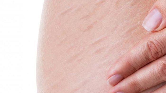 ilustrasi seseorang yang mengalami masalah stretch mark