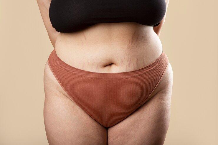 ilustrasi wanita yang mengalami stretch mark usai melahirkan