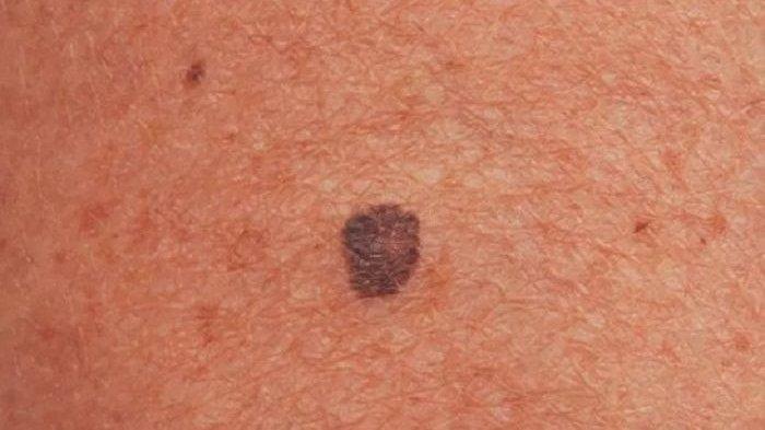 ilustrasi tahi lalat