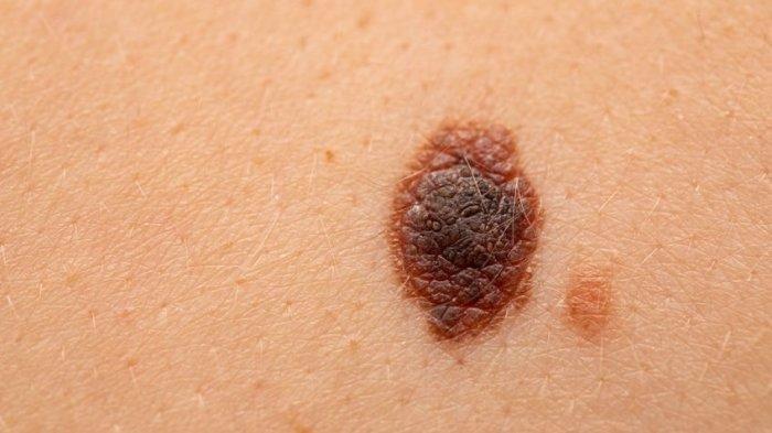 Ilustrasi tahi lalat melanoma