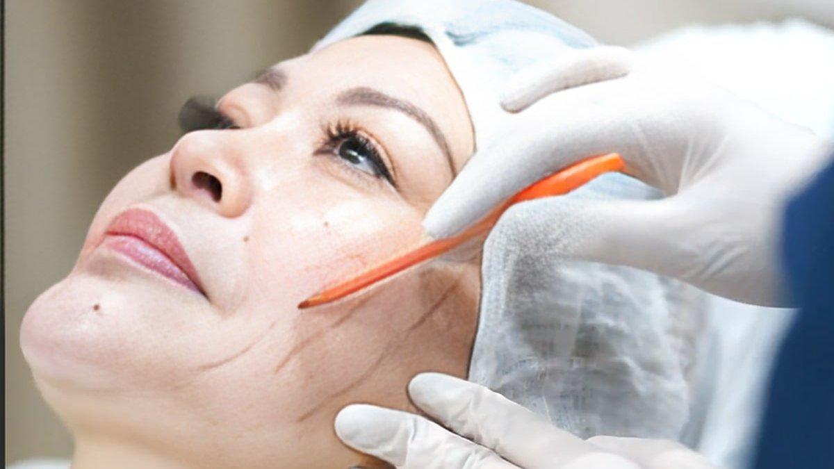 ilustrasi treatment tarik benang aptos