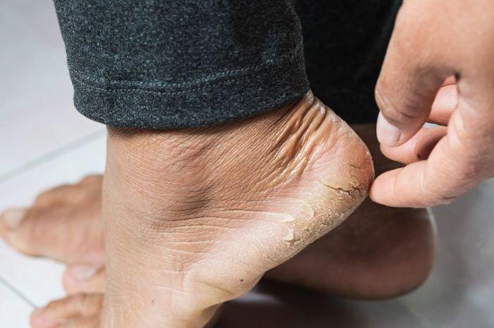 ilustrasi kaki atau tumit pecah-pecah