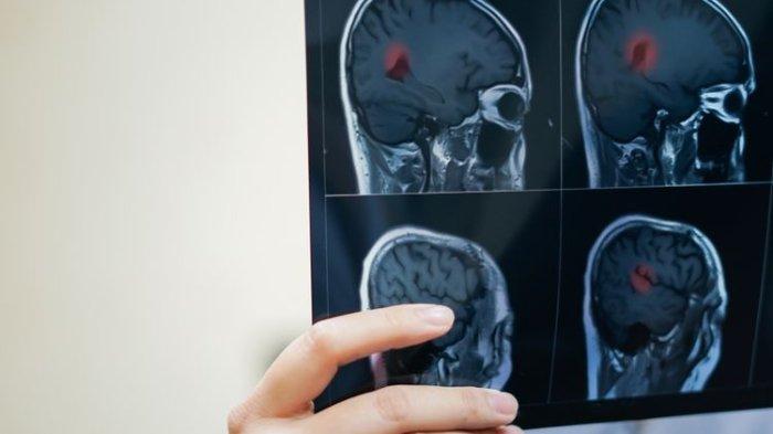 ilustrasi hasil MRI tumor otak
