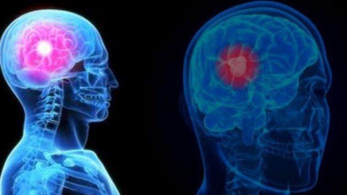 ilustrasi tumor otak