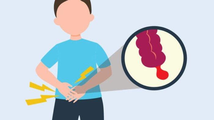 ilustrasi seseorang yang mengalami usus buntu pecah