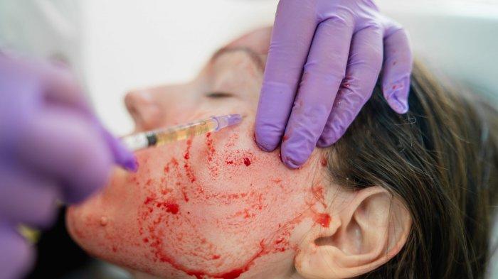ilustrasi treatment vampire facial