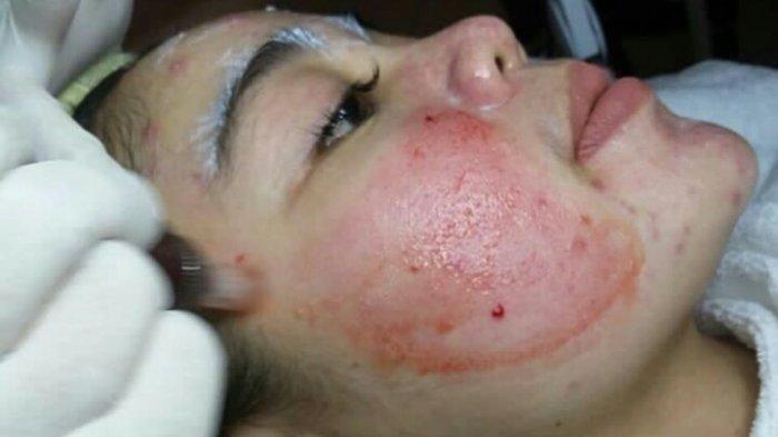 ilustrasi treatment vampire facial