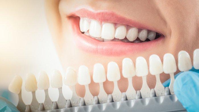 ilustrasi veneer gigi