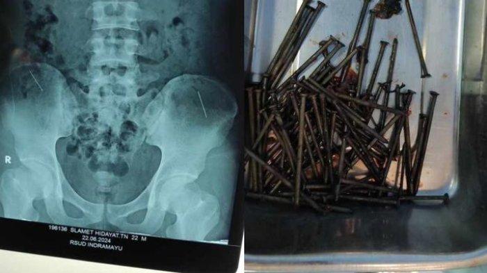 Hasil rontgen dan paku-paku yang berhasil dikeluarkan dari perut seorang pria dalam operasi di RSUD Indramayu, Sabtu (22/6/2024).