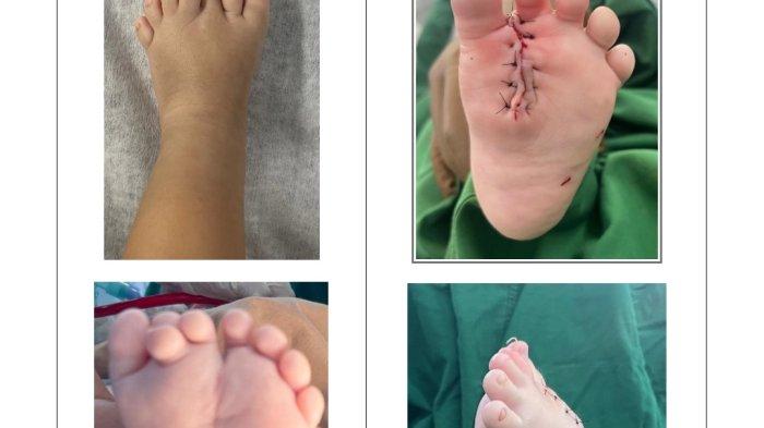 Kasus polidaktili belum lama ini ditemukan di Bandung pada seorang pasien anak berusia satu tahun berjenis kelamin laki-laki. Anak tersebut lahir dengan tiga jari tambahan pada kaki kirinya sehingga menyebabkan bentuk dan struktur kaki yang abnormal, dan akhirnya sukses ditangani oleh Prof. Dr. dr. Yoyos Dias Ismiarto, Sp.OT (K), M.Kes, CCD, dokter spesialis ortopedi konsultan ortopedi anak dari Mayapada Hospital Bandung