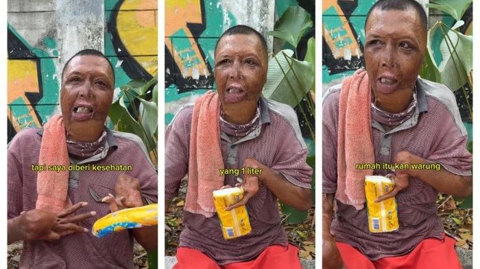Kolase Foto Korban Luka Bakar Defi penjual tisu keliling.
