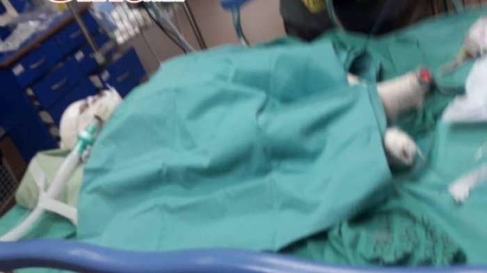 Keadaan Noor Atifah yang badannya mengalami luka bakar hingga 95 persen.