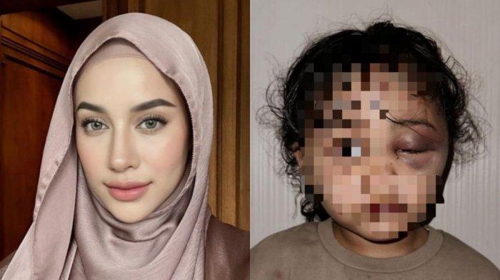 Anak Aghnia Punjabi Dianiaya Pengasuhnya