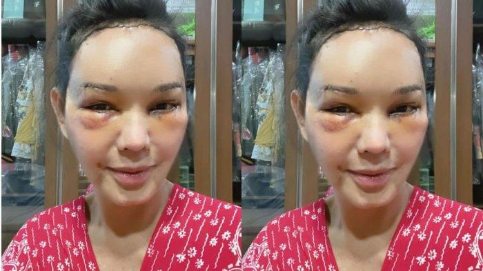 Wajah Bunda Corla Pasca Operasi Plastik