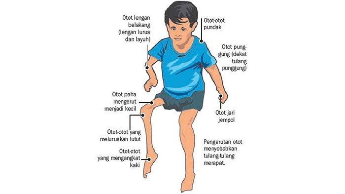 Ilustrasi Polio