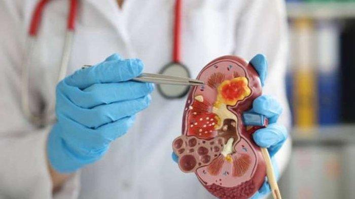 Pentingnya Minum Air Putih dalam Pencegahan Penyakit Batu Ginjal
