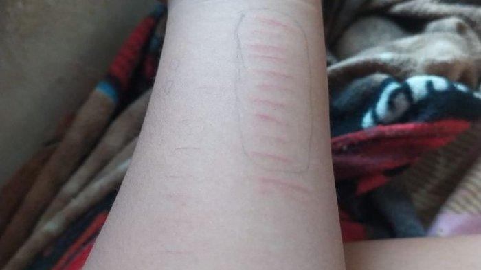 Siswa SD di Situbondo menyayat sendiri tangnnya dengan senjata tajam. (Dokumentasi Arie)