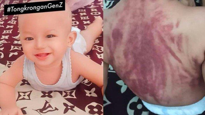 Viral punggung bayi memerah kebiruan dikerok pengasuh pakai koin karena dikira masuk angin