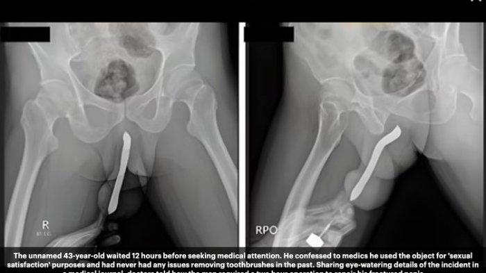 Tangka[an layar Journal of Surgery Case Reports yang memperlihatkan hasil rontgent seorang pria yang memasukkan sikat gigi ke penis. (Journal of Surgery Case Reports)