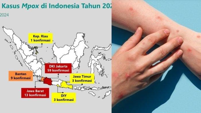 10 langkah pencegahan infeksi virus Mpox yang kini melonjak tinggi di Indonesia