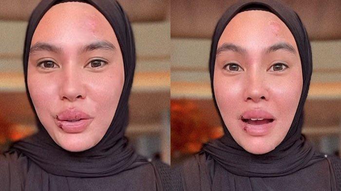 Akhirnya Kartika Putri minta maaf di tengah sakit.