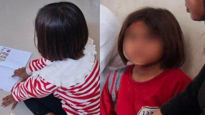Siswi Gresik yang matanya dicolok temannya dengan tusuk pentol.