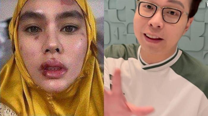 Dokter Richard Lee mau obati wajah Kartika Putri yang ruam dan melepuh. Istri Habib Usman ungkap doa baik.