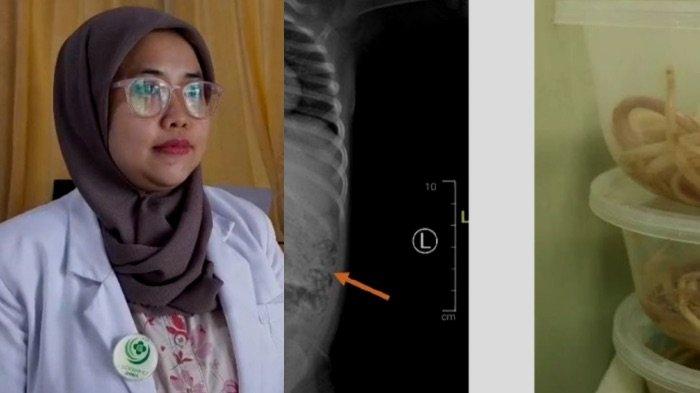 PENJELASAN DOKTER - Kepala Staf Medik Fungsiona (SMF) Bedah Anak RSD Dr. Soebandi Jember Dr. Bela Mayvani, S.pba saat memberikan penjelasan, Rabu (16/4/2025). Ternyata kebiasaan hidup tidak bersih satu diantara penyebabnya.