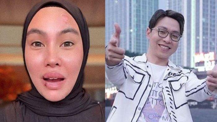 Kartika Putri obati wajah ruam dan melepuh ke Singapura. Jawab sentilan dokter Richard Lee 'pilih dokter pintar ngaji'.