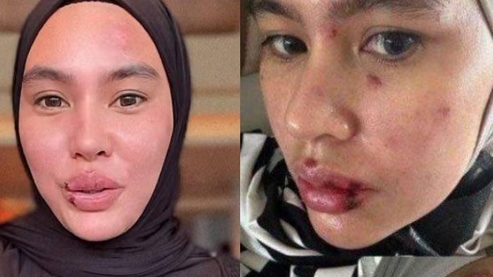Kartika Putri sempat mendapat cibiran dari netizen atas penyakitnya.