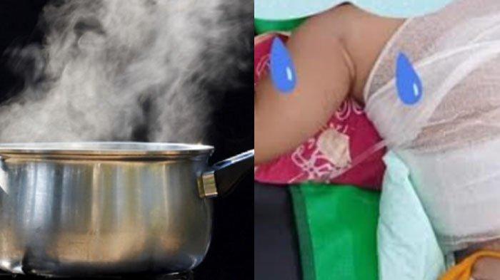 Balita 3,5 tahun di Ponorogo tercemplung ke Panci isi kuah sayur panas. Begini kondisi terkini menurut penjelasan dokter IGD RSUD dr Harjono