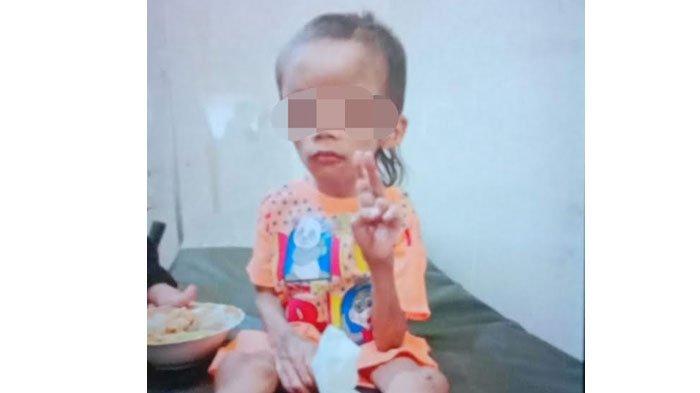 Kondisi bocah berinisial D (7) yang menjadi korban dugaan penyekapan dan disiksa saat menjalani perawatan di RSSA Kota Malang.