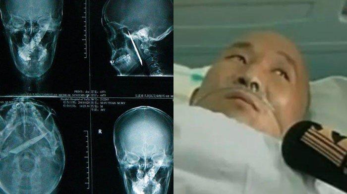 Pantas Kepala Pria ini Selalu Pusing selama 4 Tahun, Dokter Kaget Ada Pisau Karatan Menancap: Aneh