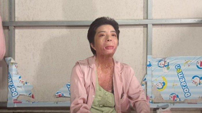 Penampilan seorang istri yang pernah dibakar suaminya ternyata tetap ikhlas karena memikirkan nasib anak