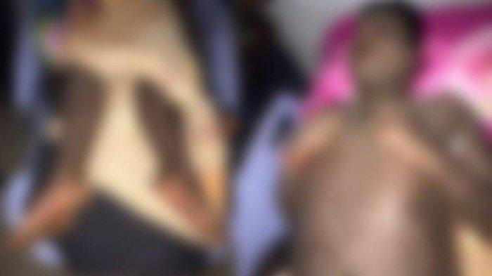 Pengakuan Pilu Ayah Remaja yang Kulitnya Bersisik karena Obat Pemutih di Bombana