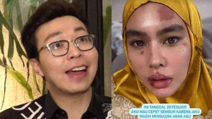 dr Richard Lee nyatakan siap bantu obati Kartika Putri yang kini wajahnya rusak kena penyakit.