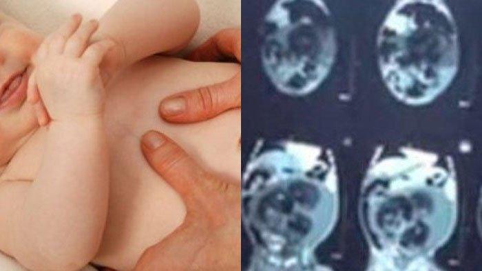 Dokter ungkap kondisi asli bayi laki-laki hamil yang viral di media sosial. Ternyata perut membesar karena penyakit serius.