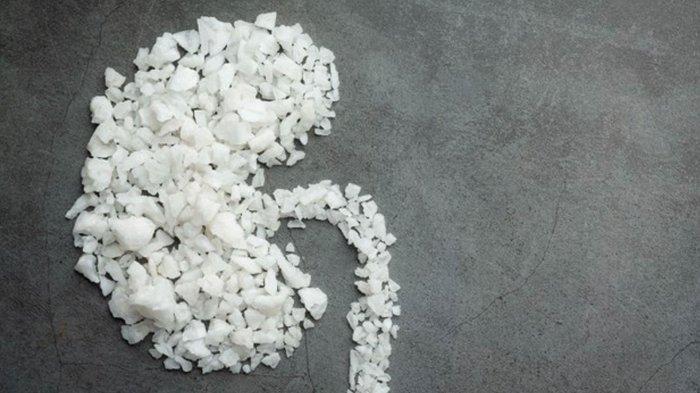 Ilustrasi batu ginjal.