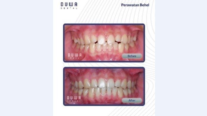 PERAWATAN ORTODONTI : Klinik Gigi Duwa Dental menghadirkan perawatan ortodonti sebagai layanan unggulan yang dimotori langsung oleh drg. Prima Ananta Putra, Sp.Ort.