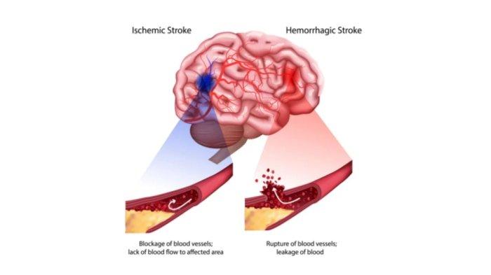 Ilustrasi penyakit stroke oleh BHF UK