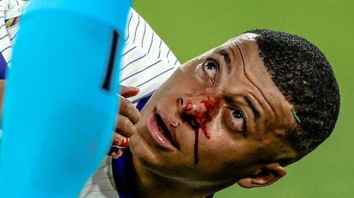Kondisi pendarahan hidung Mbape di laga melawan Austria pada Euro 2024, Selasa ( 18/6/2024)