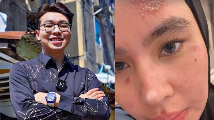 Potret dokter Richard Lee (kiri) dan Kartika Putri (kanan). Berikut reaksi Richard Lee usai Kartika Putri muka dan mulutnya ruam hingga melepuh.