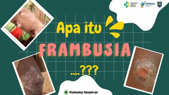 Mengenai penyakit Frambusia, masyarakat mulai mewaspadai satu di antaranya warga Kabupaten Berau, Provinsi Kalimantan Timur. 