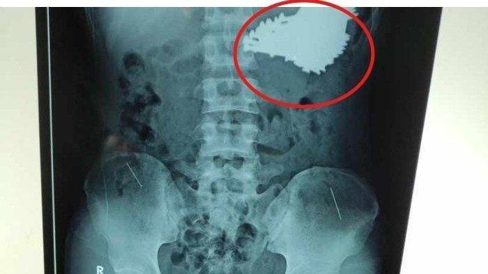 Dokter RSUD Indramayu Jawa Barat sempat syok melihat 70 batang paku di lambung pemuda di Indramayu.