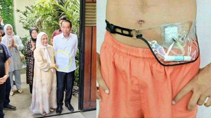 KESEHATAN JOKOWI - Kolase foto mantan Presiden RI Joko Widodo saat merayakan ulang tahun di kediamannya di Solo, pada Sabtu (21/6/2025). Perut Jokowi tampak menonjol ketika itu, Dokter Tifa sebut itu CAPD, dugaan sakit autoimun agresif pun mencuat di kalangan warganet. (Ist/KPCDI)