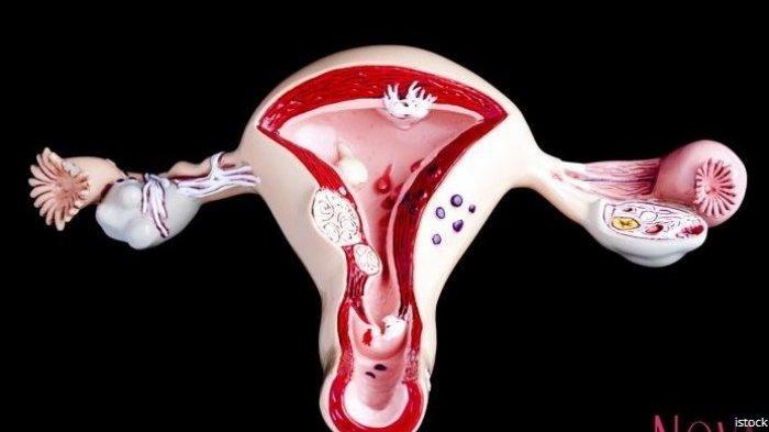 ILUSTRASI Kanker serviks. Kanker serviks menempati peringkat kedua untuk jenis kanker yang paling banyak ditemui setelah kanker payudara. Departemen Obstetri dan Ginekologi FKKMK UGM membeberkan, kanker serviks sangat bisa dicegah.